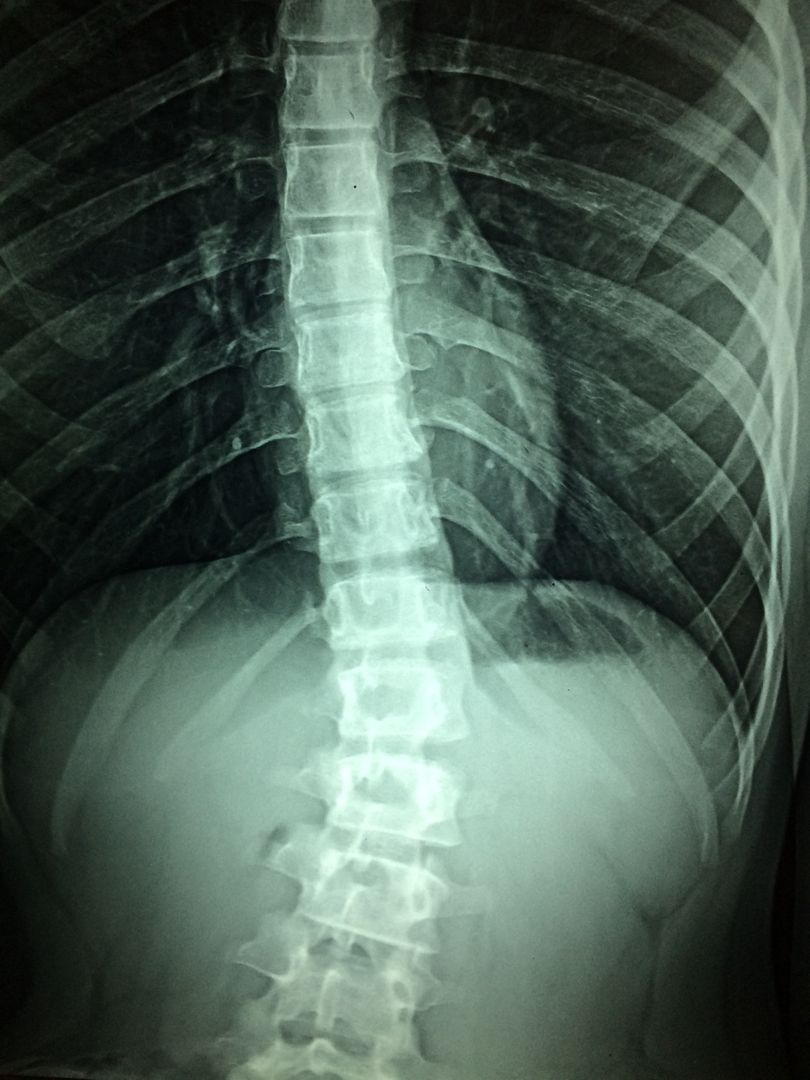 Detailed X-Ray of Scoliosis in Thoracic Spine - Free Images, Stock Photos and Pictures on Pikwizard.com