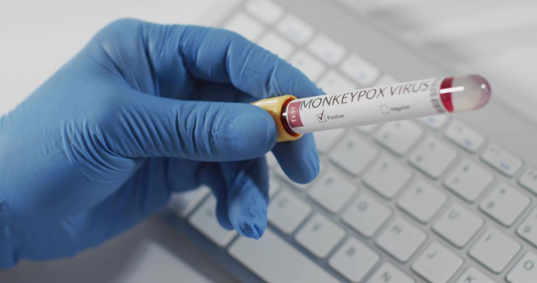 Blue Gloved Hand Holding Positive Monkeypox Blood Sample Tube Over Computer Keyboard