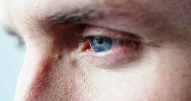 Close-up of a Caucasian person's eye showing a bruised skin area, with copy space. It suggests a recent injury or accident, requiring medical attention.