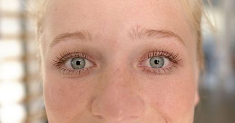 Close-up of Woman's Blue Eyes, Focused on Rehabilitation