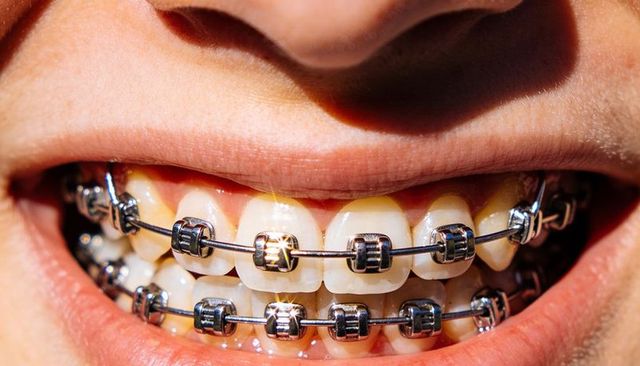 Smiling mouth wearing metal braces close-up showing brackets, archwire, teeth alignment