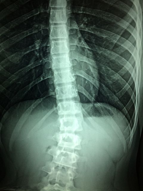 Image shows an x-ray scan revealing scoliosis in the thoracic spine area. Ideal for illustrating medical articles on spinal disorders, healthcare brochures, educational materials for medical students, or presentations focused on spinal health and radiological procedures.