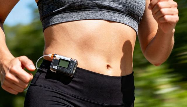Female runner wearing insulin pump while running outdoors on trail