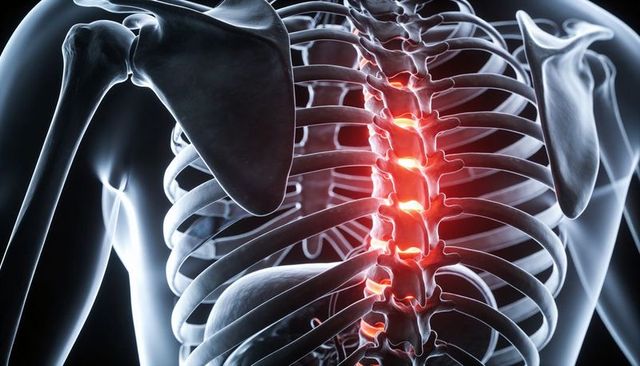Thoracic spine highlighting inflamed vertebrae and disc spaces with translucent rib cage