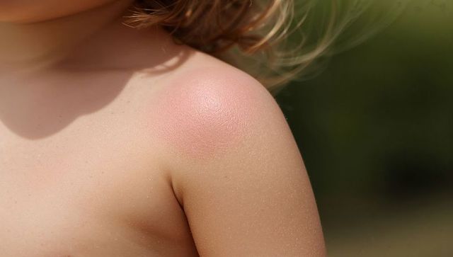 Sunburned toddler shoulder with freckles and blonde hair in meadow highlighting sun safety