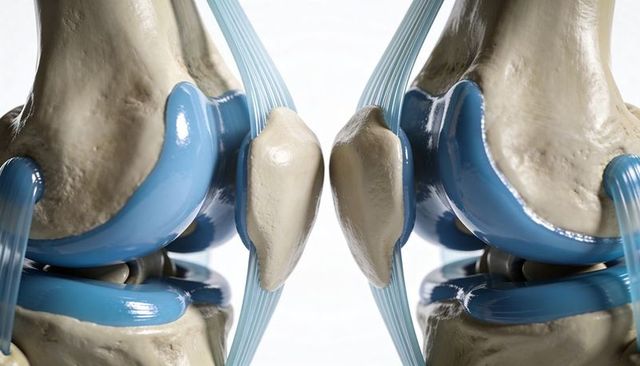 Paired knee anatomy close-up showing femur, tibia, patella, menisci, ligaments