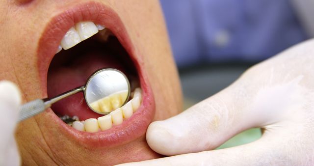 Close-up of dentist examining a woman with dental tools in dental clinic 4k