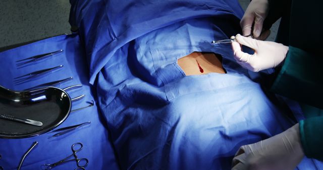 A surgeon is preparing to operate on a patient's back in an operating room. The patient is covered with blue surgical drapes, with a small incision on their back. Nearby are various surgical tools and instruments, indicating a serious medical procedure. This image is ideal for medical, healthcare, and surgery-related publications and websites.