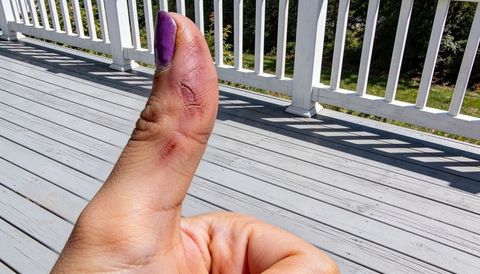 Close-up thumb with purple nail polish and healing scabs on sunlit wooden porch deck