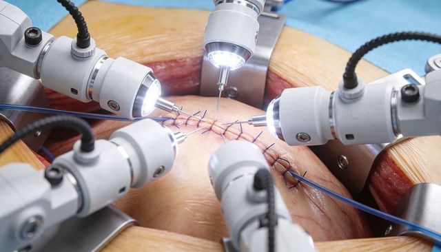 Robotic surgical arms performing precise suturing on midline abdominal incision