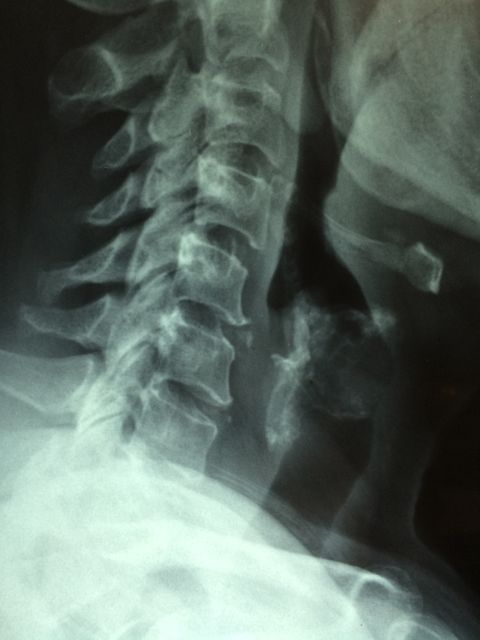 Highly detailed X-ray showing the cervical spinal section. Clearly shows vertebrae, aiding in medical discussions, educational materials for students or doctors, and healthcare documentation.