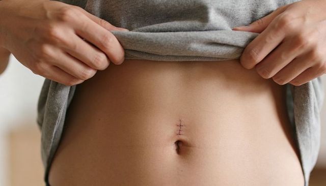Woman lifting grey shirt revealing sutured incision above navel closeup for post-op care