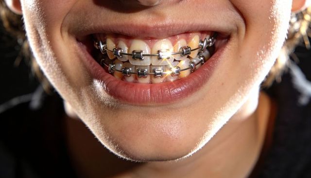 Teen smiling showing dual metal braces with shining brackets and archwire close-up
