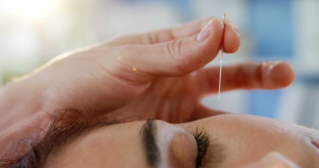 Close-Up of Acupuncture Needle Being Placed on Forehead - Download Free Stock Images Pikwizard.com
