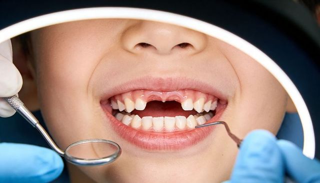 Pediatric dentist examining missing front baby teeth, child showing gap at checkup