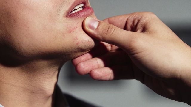 Examining male chin acne and jawline abrasions with hand closeup for dermatology