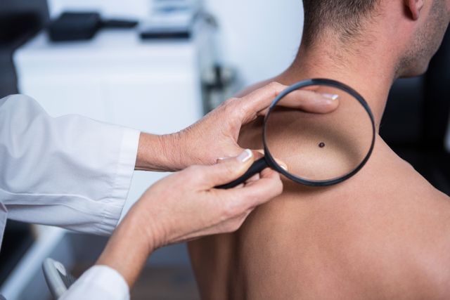 Dermatologist examining mole with magnifying glass in clinic