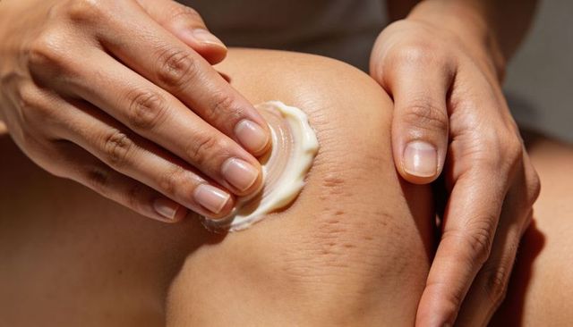 Applying Moisturizer to Knee Showing Stretch Marks and Natural Skin Texture Closeup At Home