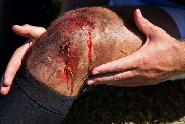This image shows a close-up of a rugby player's injured knee with visible bleeding and grass stuck to the wound. Hands are gently holding the knee, indicating pain and the need for medical attention. This image can be used in articles or advertisements related to sports injuries, first aid, healthcare, and athletic training.
