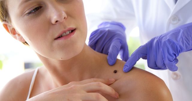 Dermatologist examining a mole on a female patient's shoulder, highlighting the importance of regular skin checks and health assessments. Useful for illustrating topics related to skincare, dermatology, mole evaluation, and preventive health measures.
