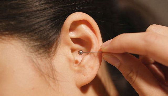 Practitioner inserting auricular acupuncture needle into ear for pain relief and wellness