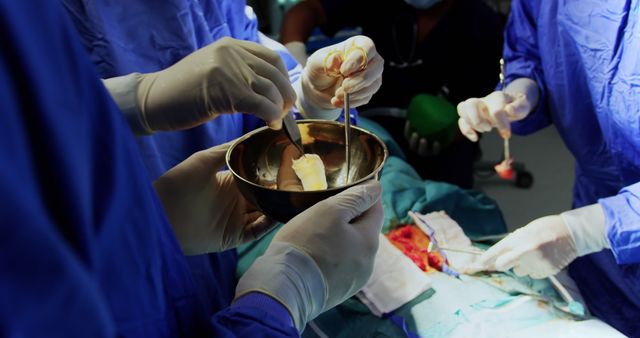 Medical Team Performing Surgical Procedure in Operating Room - Download Free Stock Images Pikwizard.com