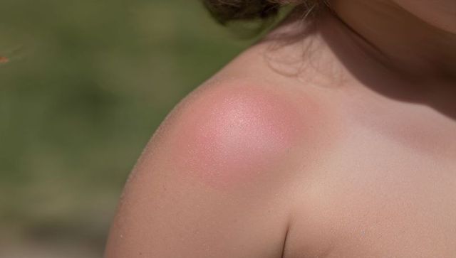 Closeup showing child sunburned right shoulder during summer park play