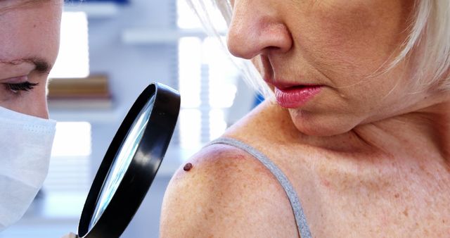 Dermatologist closely examining mole on patient's shoulder using magnifier. Ideal for articles or resources about skin health, skin cancer awareness, dermatological checkups, mature woman health, and preventative healthcare.
