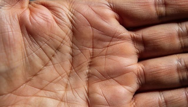 Showing palm lines and skin texture on dark skin close-up for dermatology and forensics